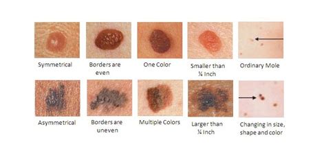 Telltale Signs Of Skin Cancer Revealed Uk