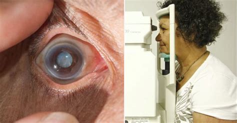 Glaucoma O Que é Sintomas E Causas