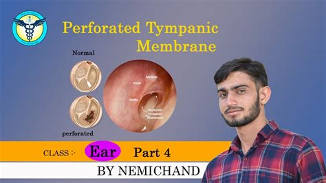 Tympanic Membrane Perforation Part 4 Youtube
