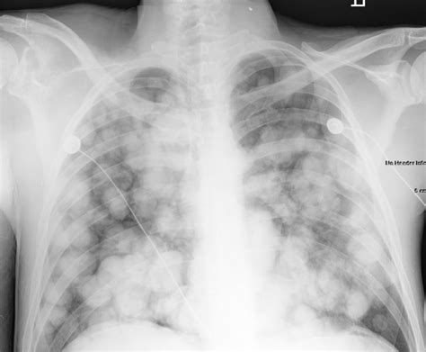 Dr andrew dixon ◉ and dr jeremy jones ◉ et al. Metastasis chest x ray - wikidoc