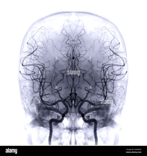 Cerebral Angiography Image From Fluoroscopy In Intervention Radiology