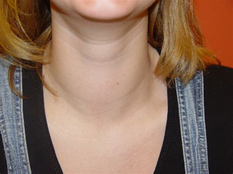 10000 Strong Against Thyroid Cancer Thyroid Nodules Thyroid Lumps