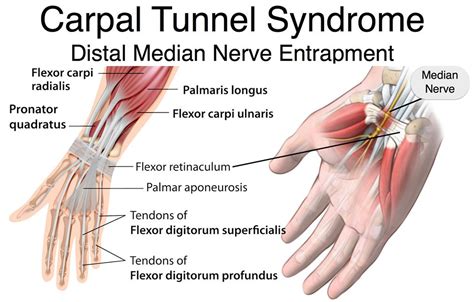 Carpal Tunnel Syndrome Causes Treatment Splint And Surgery