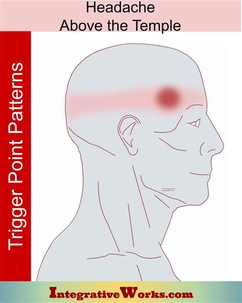 Trigger Point Patterns Headaches Cervicogenic In 2022 Trigger
