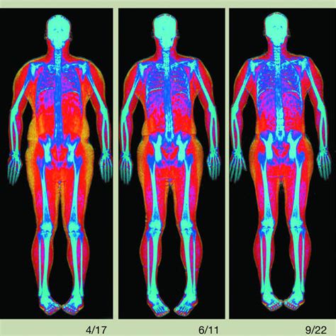 Too Much Fat Try A Whole Body Scan Wsj
