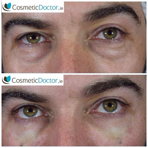 Tear Trough Before And After Cosmetic Doctor Dublin Cosmetic Doctor