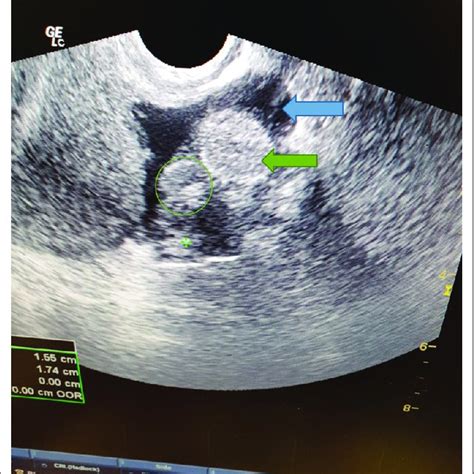 Pelvic Pain Adnexal Masses And Ultrasound My Xxx Hot Girl