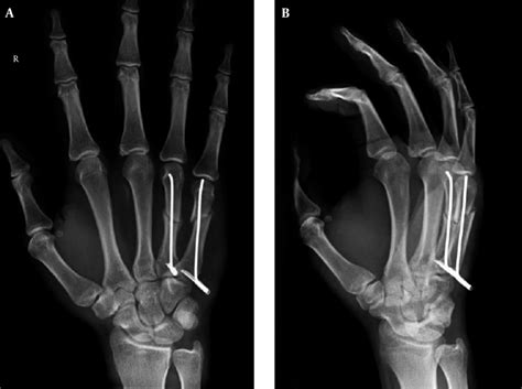 Intramedullary Fixation Of Metacarpal Fractures With Commercially