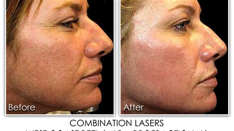 5 Combination Laser Skin Rejuvenation Clinic Skin Rejuvenation Clinic