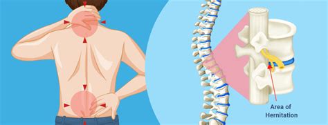 Getting The Pinched Nerve In Shoulder Treatment At Home To Work Nerve