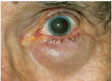 Eyelid Lymphoid Plasmacytic And Metastatic Tumors Ento Key