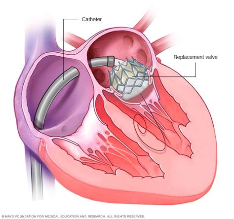 Mitral Valve Repair And Mitral Valve Replacement Care At Mayo Clinic Mayo Clinic