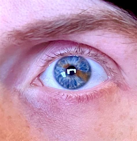 My Left Eye Has Two Colors Rmildlyinteresting
