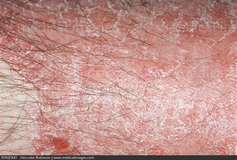 Stock Image Dermatology Psoriasis A Deep Pink Patch With Dry White