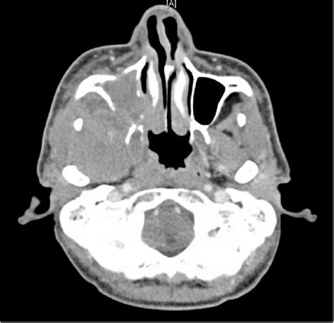Ct Neck With Contrast Soft Tissue Window Axial Cut Showed Soft Tissue