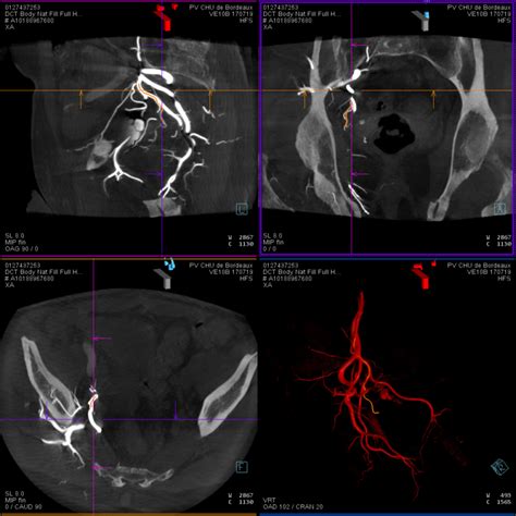Embolisation De La Prostate Radiologie Interventionnelle Embolisation