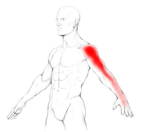 Infraspinatus Muscle Pain And Trigger Points