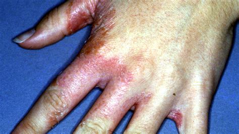 Does Hand Sanitizer Kill Ringworm Can Hand Sanitizer Kill Ringworm