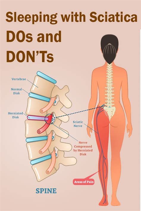 Herniated disc pain is often worse at night, but with the right knowledge, you can choose sleeping positions that soothe your symptoms. Best Sleeping Position For Herniated Disc - Aline Art