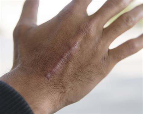 Scarring And Keloid Scarring Thames Skin Clinic