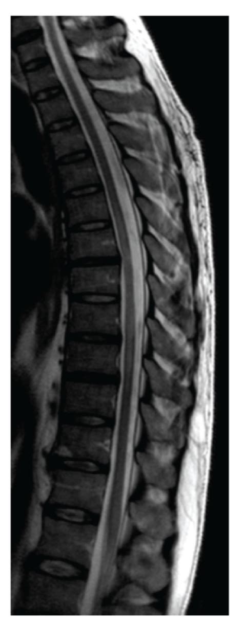 Sagittal T2 Weighted Spinal Mri 2 Months Later Shows Complete