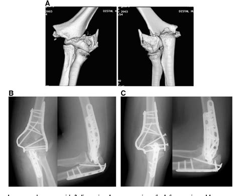 Distal Humerus Intra Articular Fractures Open Reduction Internal My