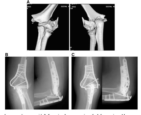 Figure 1 from Low transcondylar fractures of the distal ...