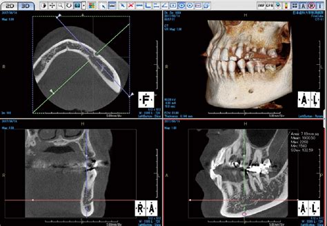 Figure 1 From Aging And Cortical Bone Density Of Mandible With Cbct