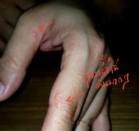 การเกิดอาการมีตุ่มน้ำใสเล็กๆที่นิ้วมือนิ้วเท้าหรือบางครั้งอาจจะเป็นที่ฝ่ามือฝ่าเท้าด้วยจะคันมาก