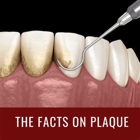 The Facts On Plaque West Palm Beach Dentist