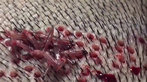 34 видео 271 просмотр обновлен 4 нояб. Hair transplantation surgery close up - YouTube