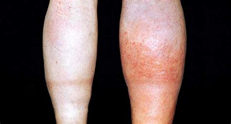 Signs And Symptoms Of Blood Clot In Leg