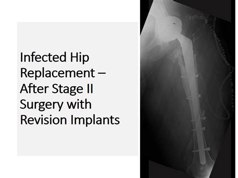 Revision Hip Replacement Surgery In Bangalore Symptoms Of Failed Hip