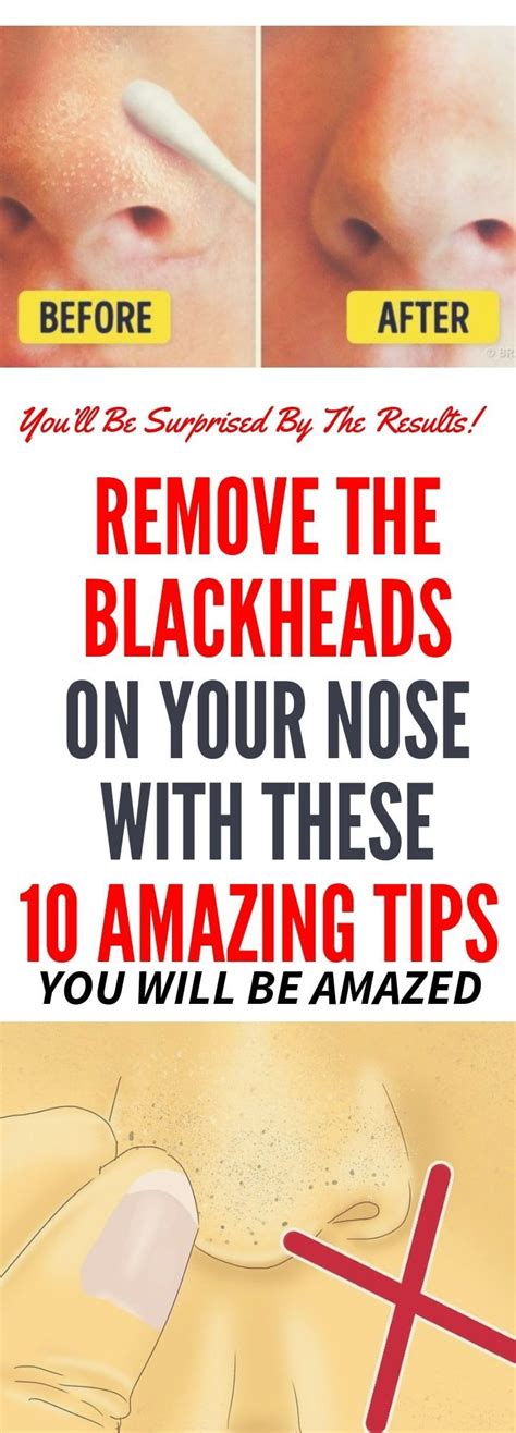 Remove The Blackheads On Your Nose With These 10 Amazing Tips