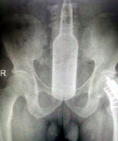 60 Year Old Chinese Man Has 7 Inch Glass Bottle Removed From Rectum After Using It As Scratcher