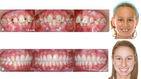 Peut On Faire De La Boxe Avec Un Appareil Dentaire - Malocclusions dentaires "Classe 2" traitées en orthodontie | Bücco