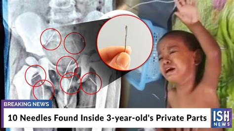 10 Needles Found Inside 3 Year Olds Private Parts Youtube