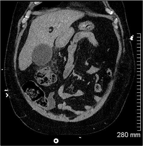 Coronal Ct Abdomen Showing A Distended Gallbladder And Pericholecystic