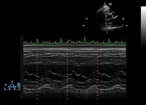 M-mode echo: principles and classic findings - wikidoc