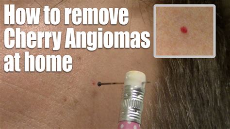 How To Remove Red Skin Dots At Home Quick And Easy Cherry Angioma