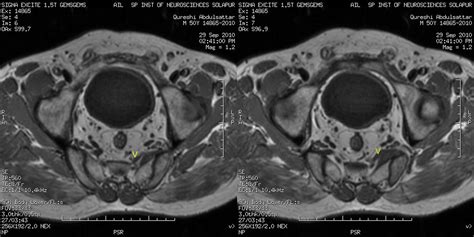 Dr Balaji Anvekar Frcr Pyriformis Syndrome Mri