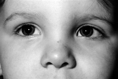 The Midline Nasal Lesion Archives Of Disease In Childhood