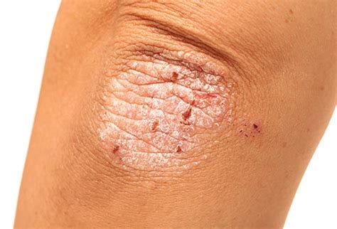 Skin Problems during Pregnancy - Medi Connect India
