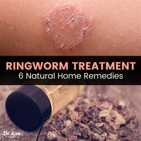 Ringworm Treatment Try These 6 Natural Remedies Dr Axe