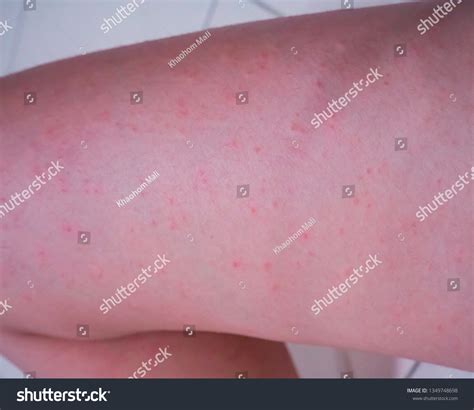 Skin Leg Itching Rashred Spots On Foto De Stock 1349748698 Shutterstock