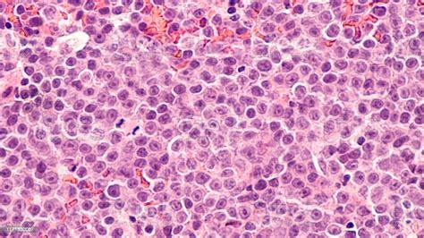 Diffuse Large B Cell Lymphomas