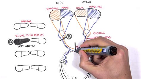 Visual Pathway And Lesions Youtube