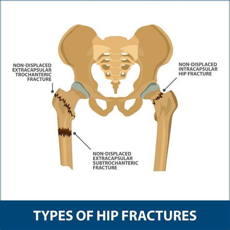 Hip Fracture Diagram