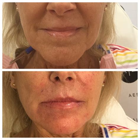 Beforeafter Botox Filler Kybella Laser Skin Care Augusta Ga