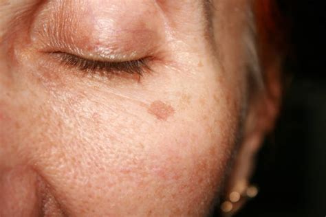 Dark Spots On Face Causes And Treatment Repc